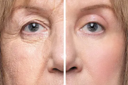 Blépharoplastie-lahlou-cabinet-lahlou-lamia